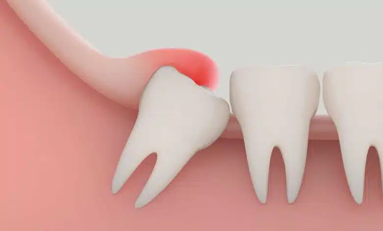 Wisdom Teeth A guide to your oral health