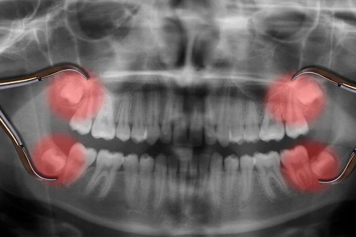 Wisdom Teeth A guide to your oral health