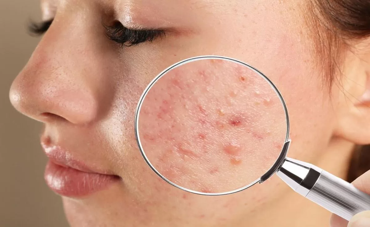 Does your daily routine cause acne for you? Here's how to stop it