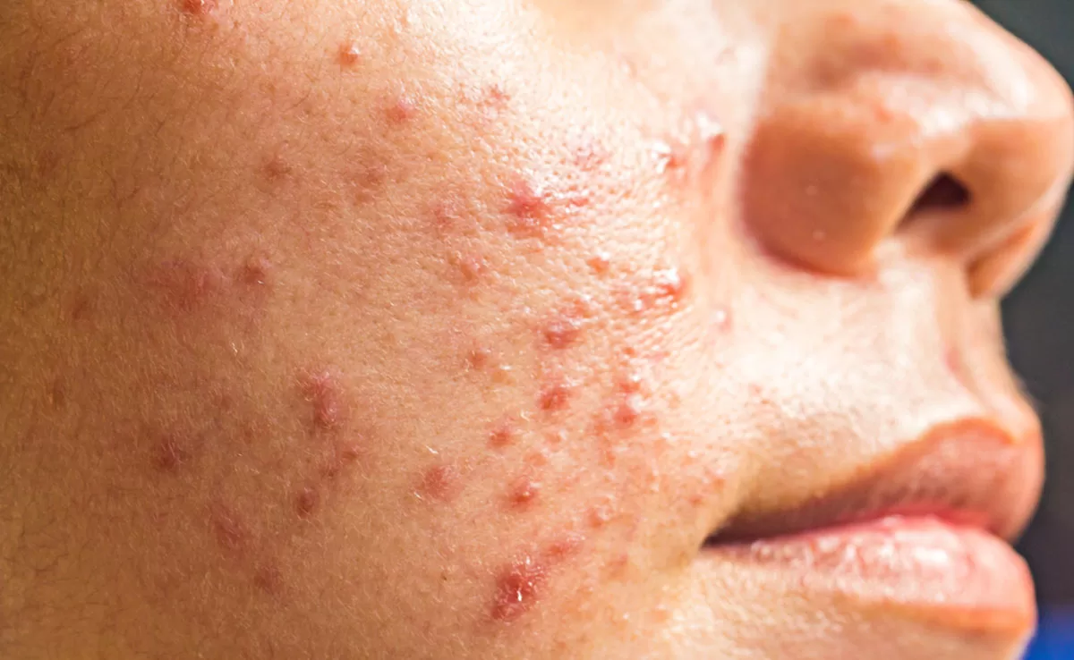 Does your daily routine cause acne for you? Here's how to stop it