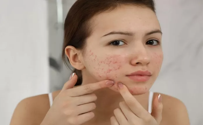 Does your daily routine cause acne for you? Here's how to stop it