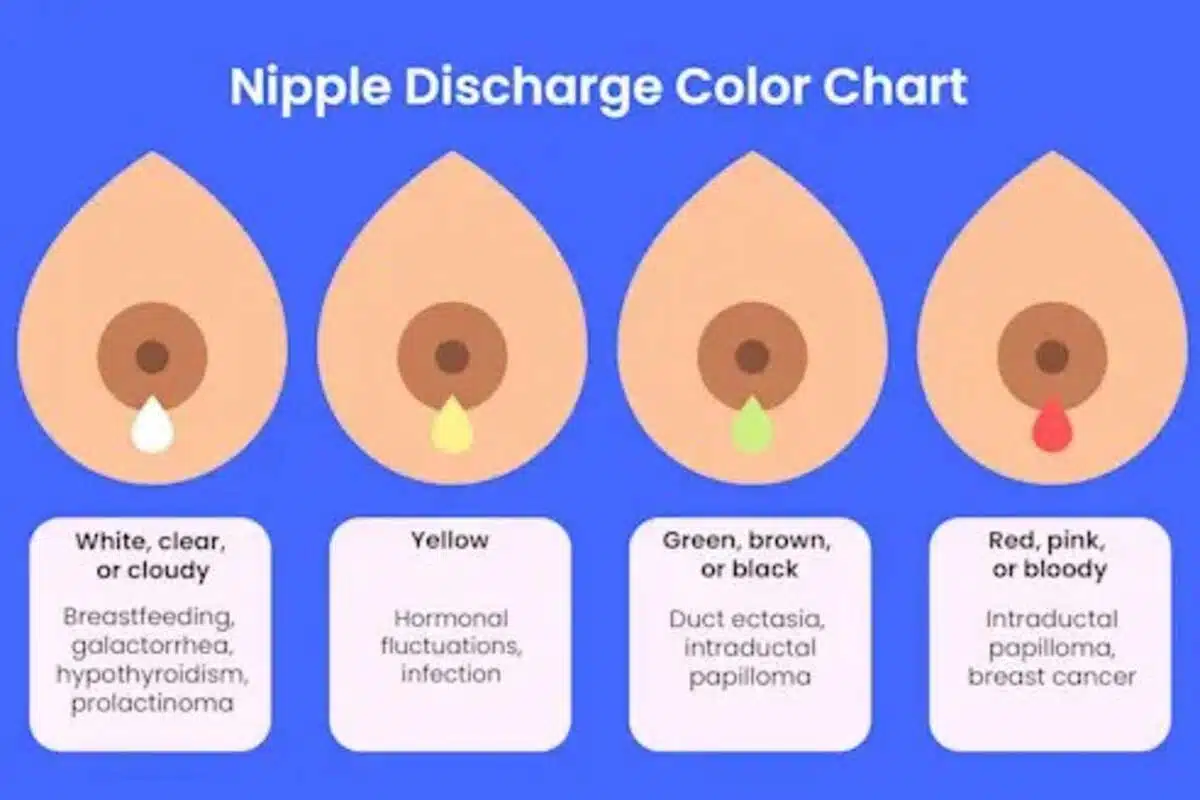 Breast Discharge A Comprehensive Overview