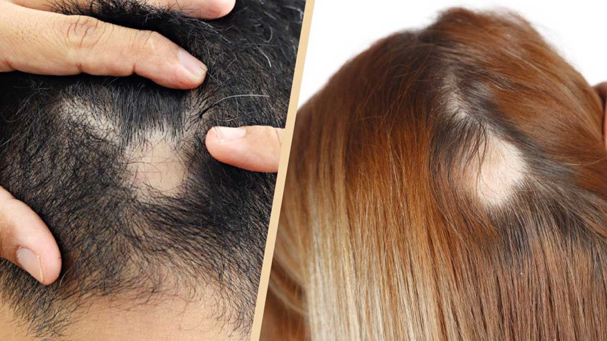 Understanding Alopecia A Comprehensive Overview