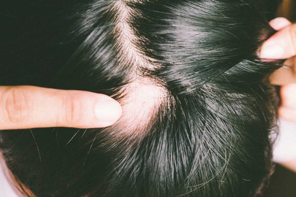 Understanding Alopecia A Comprehensive Overview