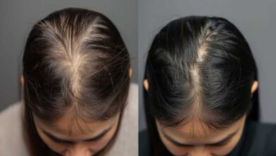Understanding Alopecia A Comprehensive Overview