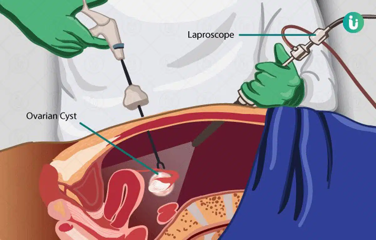 Understanding PCOD A Comprehensive Overview