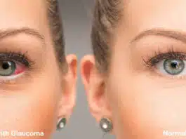 Complete information about Glaucoma