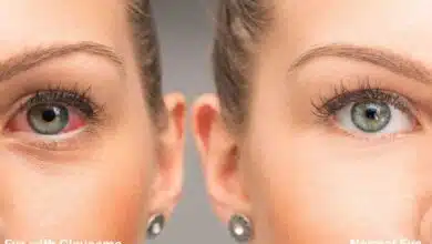 Complete information about Glaucoma