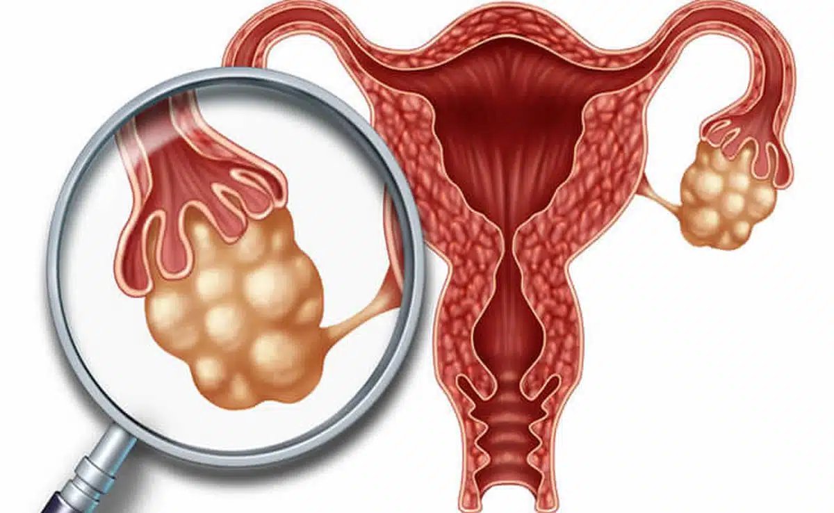 PCOS: Causes, Symptoms, Treatment and Management