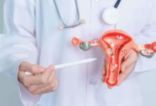 PCOS: Causes, Symptoms, Treatment and Management