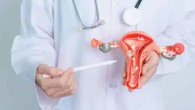 PCOS: Causes, Symptoms, Treatment and Management