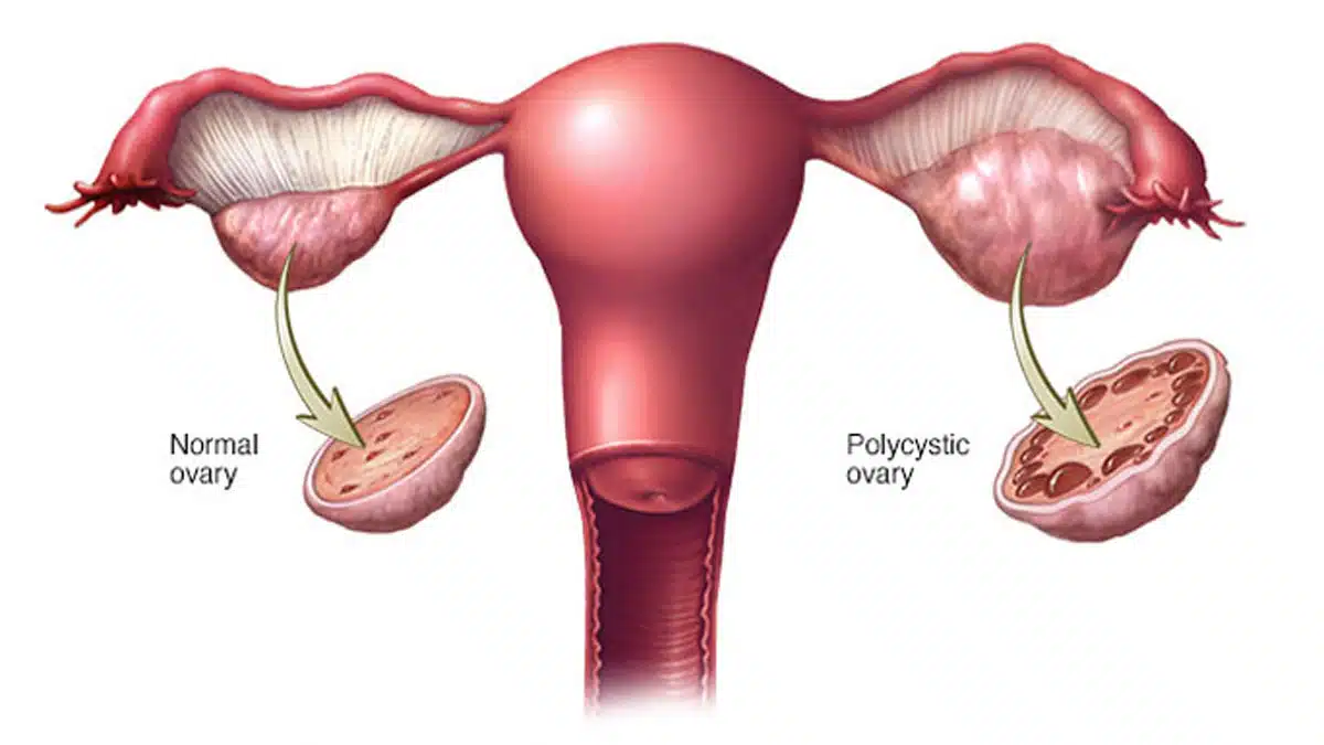 PCOS: Causes, Symptoms, Treatment and Management