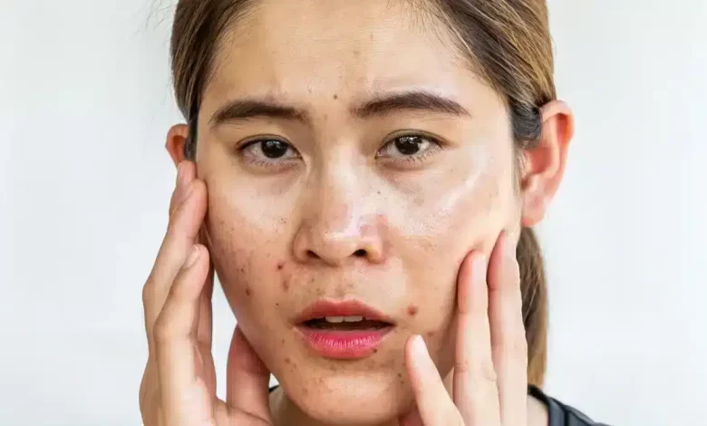Easy summer tips to take care of oily skin!