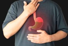 Frequent Acidity Try these simple diet changes!