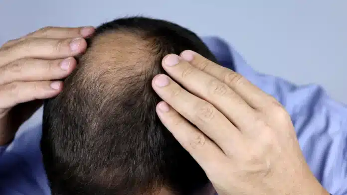 Get rid of Baldness Grow hair with home remedies