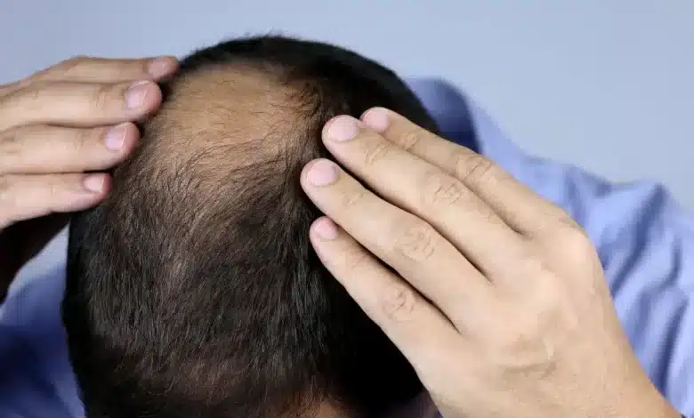 Get rid of Baldness Grow hair with home remedies