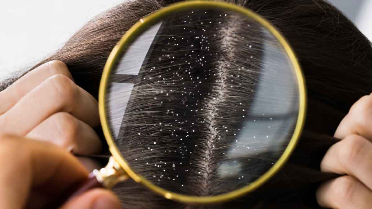 Get rid of Dandruff, prevent hair fall – 4 tips!