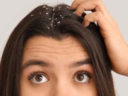 Get rid of Dandruff, prevent hair fall – 4 tips!