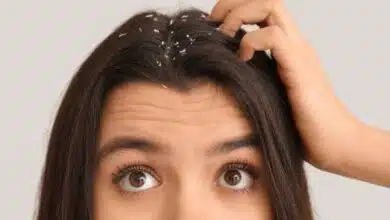 Get rid of Dandruff, prevent hair fall – 4 tips!