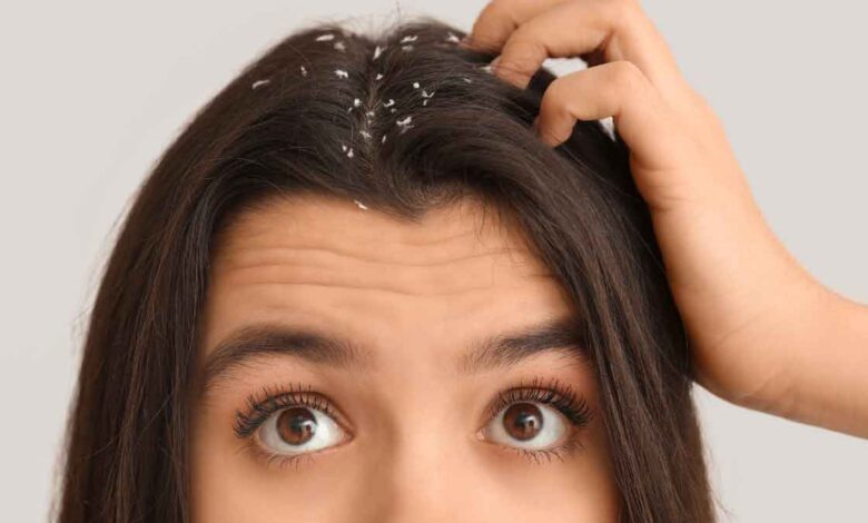 Get rid of Dandruff, prevent hair fall – 4 tips!