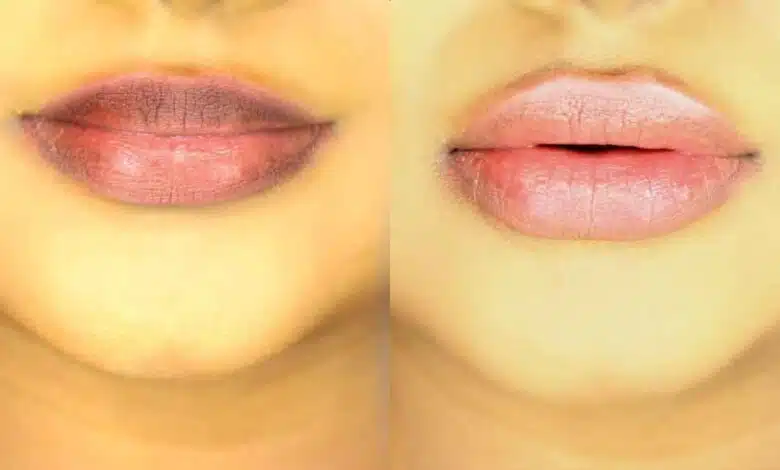 Kidney patients should stay away from these 8 pulses!