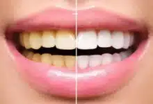 Remove yellowness from your teeth and get shine with these 5 remedies