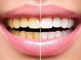 Remove yellowness from your teeth and get shine with these 5 remedies