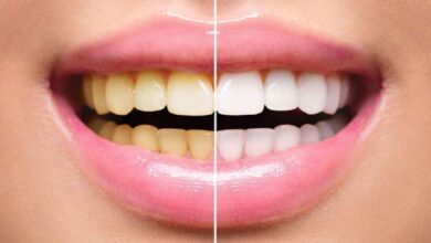Remove yellowness from your teeth and get shine with these 5 remedies