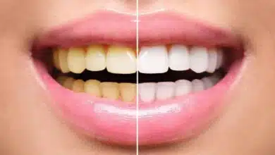 Remove yellowness from your teeth and get shine with these 5 remedies
