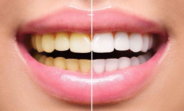 Remove yellowness from your teeth and get shine with these 5 remedies