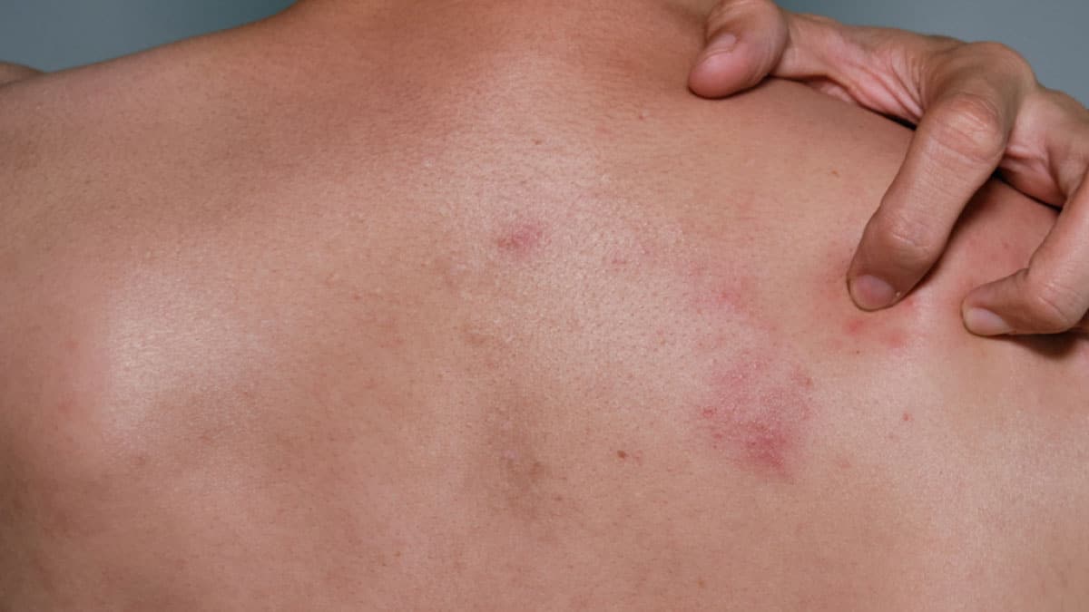 Shingles 1 Shingles: Causes, Symptoms and Treatment