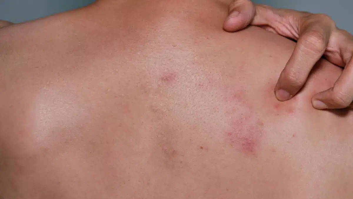 Shingles: Causes, Symptoms and Treatment