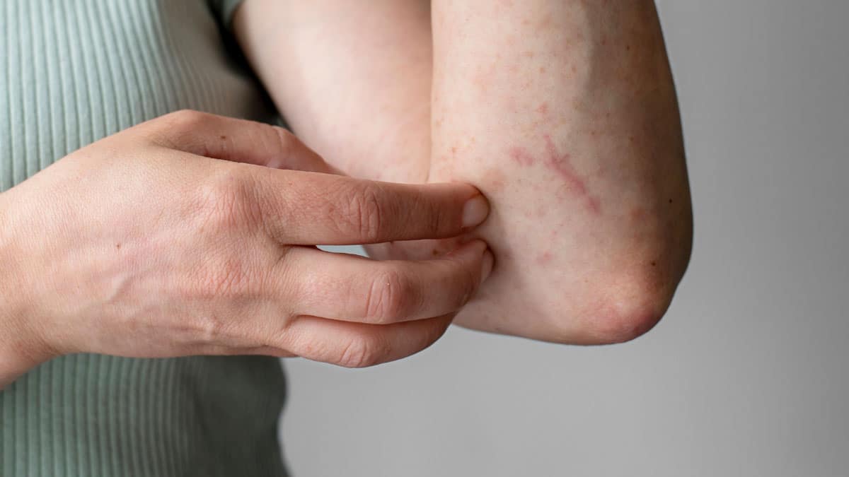 Shingles 2 Shingles: Causes, Symptoms and Treatment