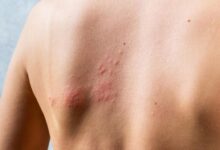 Shingles: Causes, Symptoms and Treatment