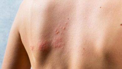 Shingles: Causes, Symptoms and Treatment