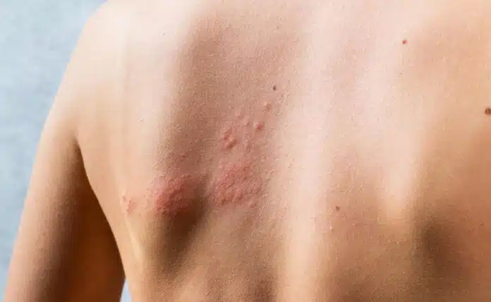 Shingles: Causes, Symptoms and Treatment