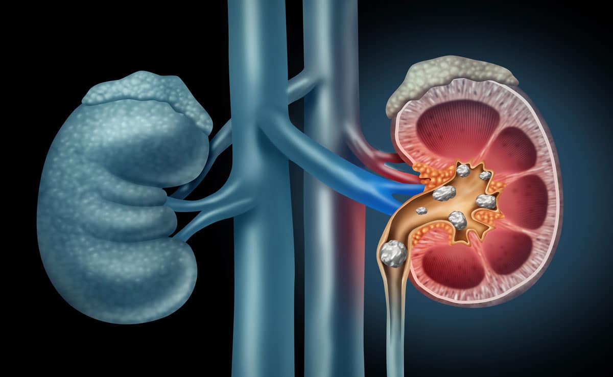 World Kidney Day 2025: Know the causes, symptoms, treatment and prevention of kidney stones