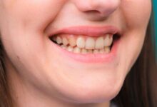 Embarrassed by yellow teeth? Then make them shine like pearls with these easy home remedies