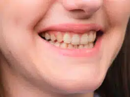 Embarrassed by yellow teeth? Then make them shine like pearls with these easy home remedies
