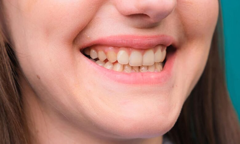 Embarrassed by yellow teeth? Then make them shine like pearls with these easy home remedies