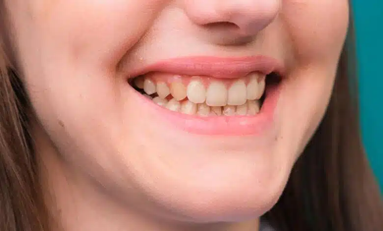 Embarrassed by yellow teeth? Then make them shine like pearls with these easy home remedies