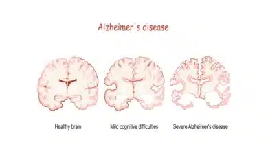 Alzheimer's Disease: Complete Information