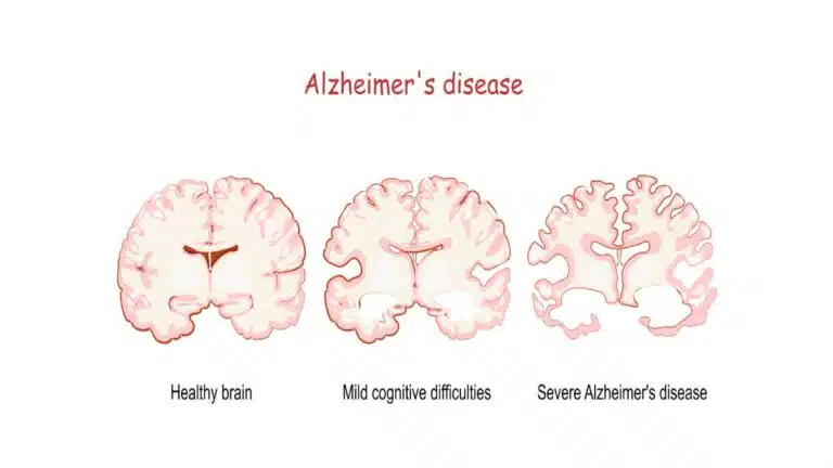 Alzheimer रोग: कारण, लक्षण, उपचार और बचाव की सम्पूर्ण जानकारी