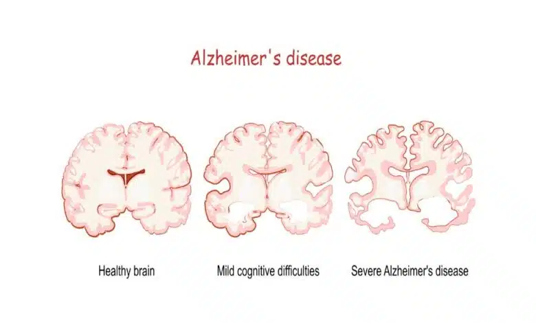 Alzheimer's Disease: Complete Information