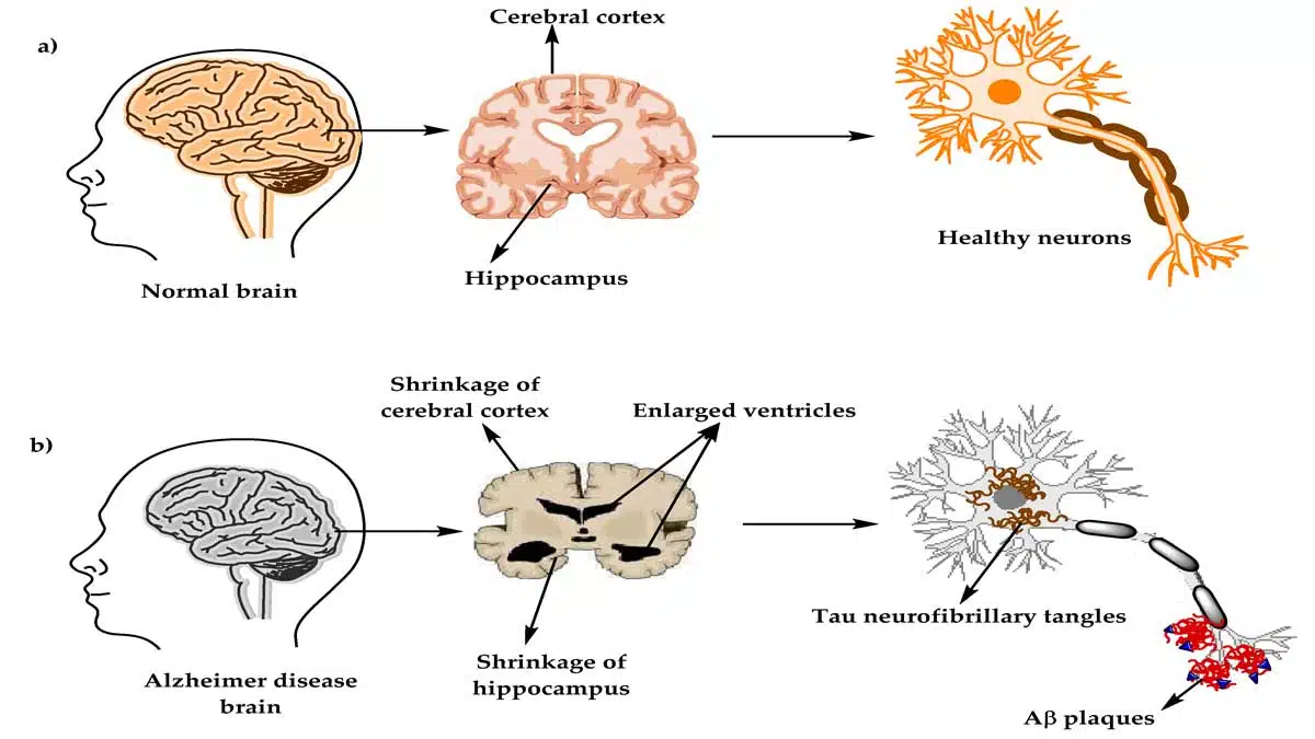 Alzheimer's Disease: Complete Information
