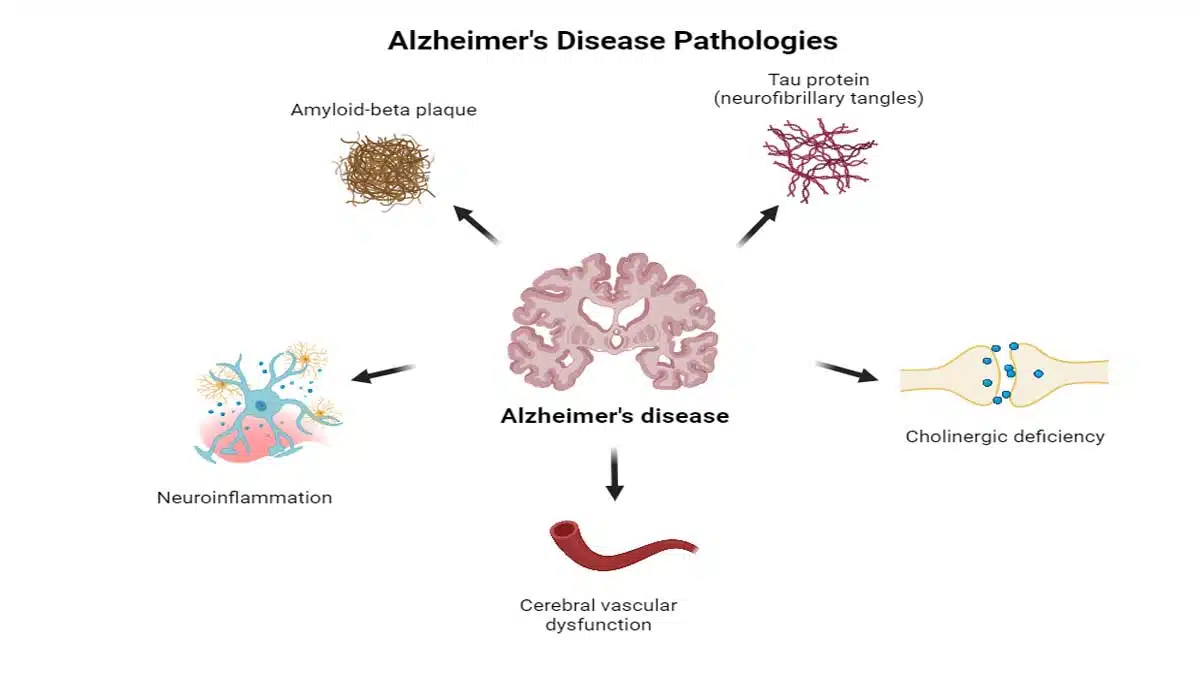 Alzheimer's Disease: Complete Information