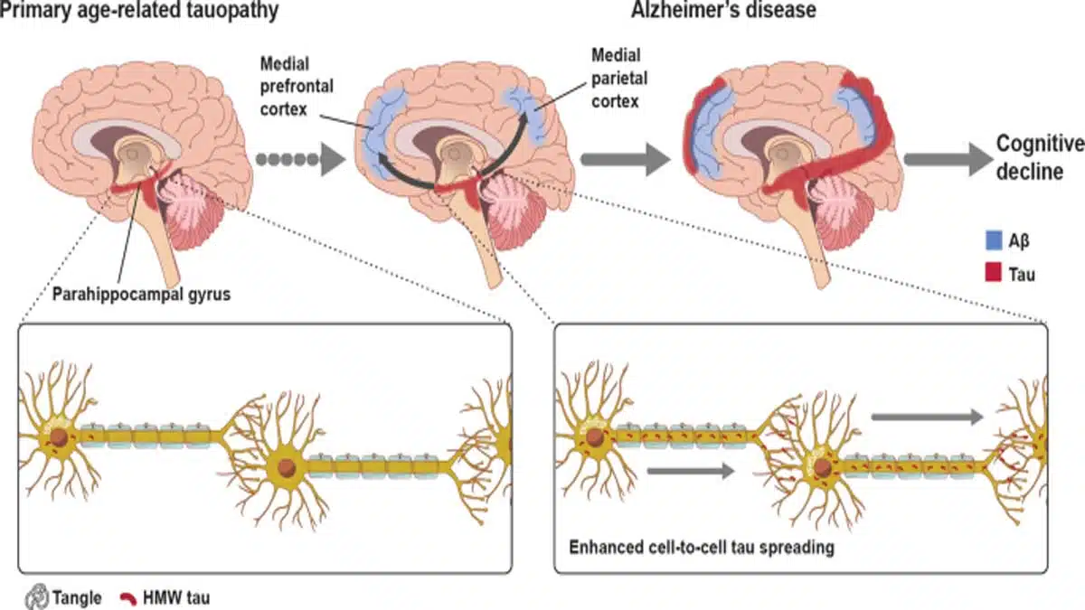 Alzheimer's Disease: Complete Information