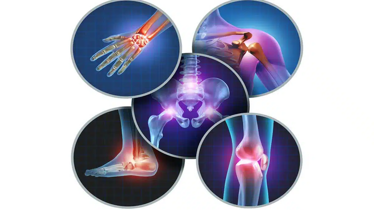 Arthritis: Causes, Symptoms, and Treatment