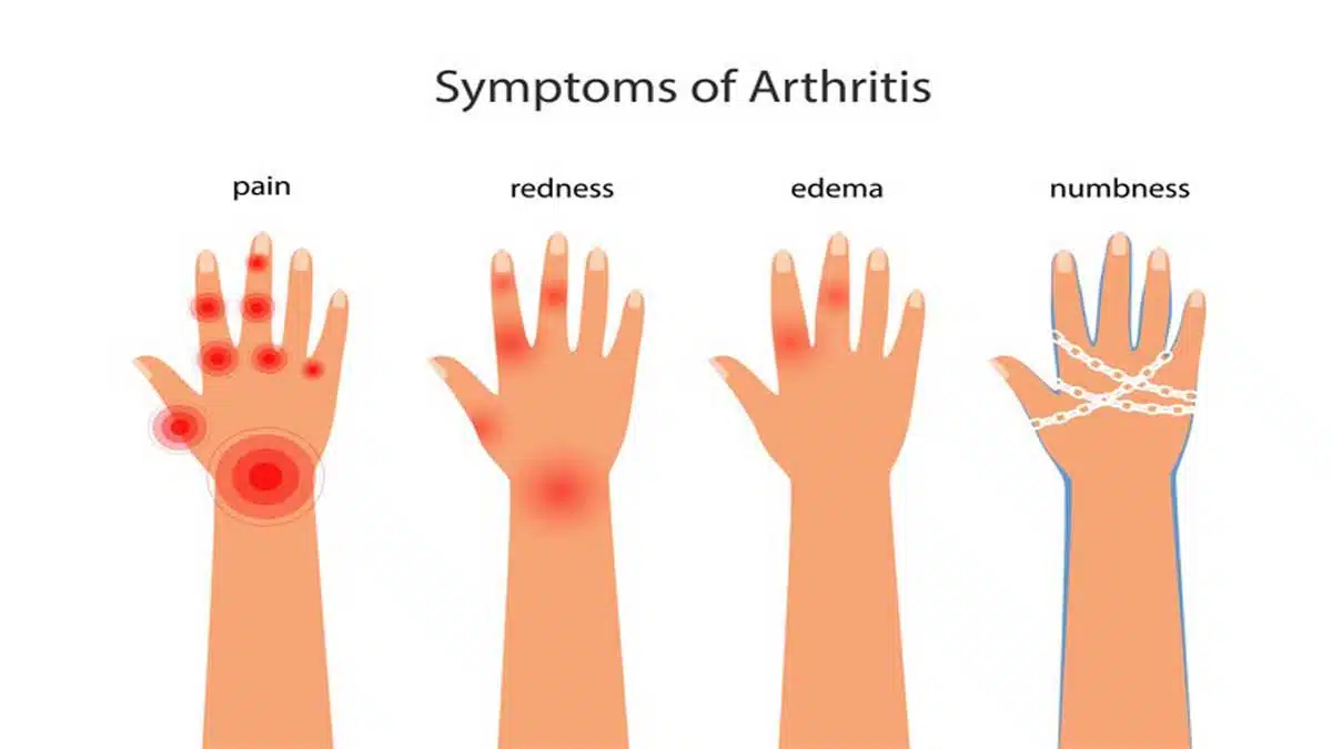 Arthritis: Causes, Symptoms, and Treatment