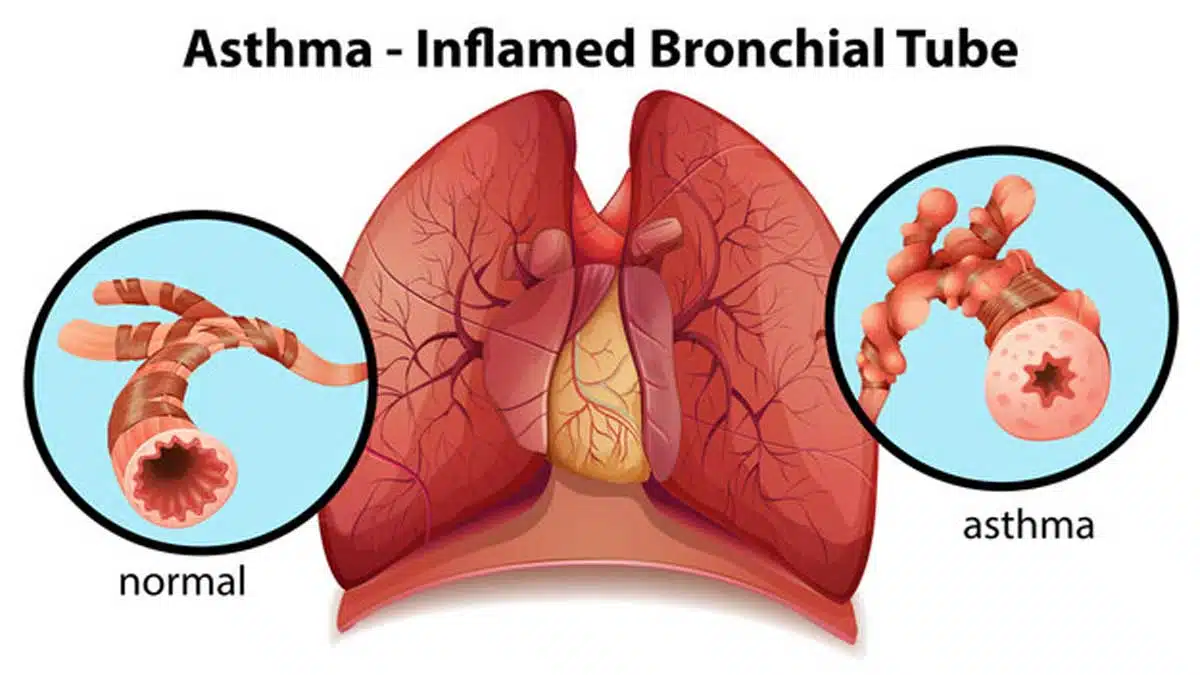 Asthma: Symptoms, Causes, Treatment
